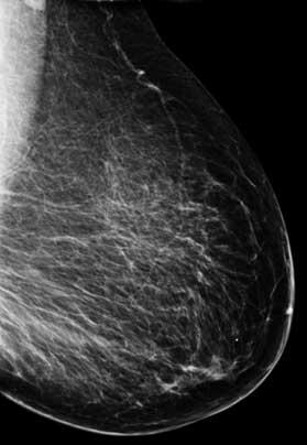 Mammogram łatwy przypadek Z wiekiem pierś staje się bardziej tłuszczowa i zawiera mniej