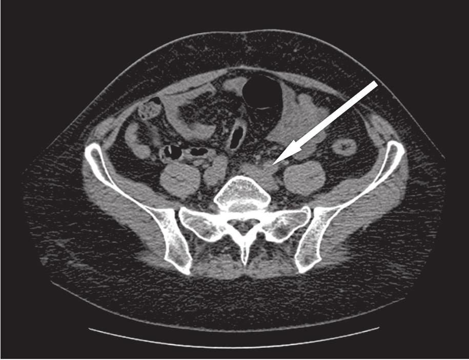 chromograniny A) oraz oceną stopnia A jego złośliwości histologicznej (z wykorzystaniem wskaźnika aktywności proliferacyjnej Ki-67) [4 6].