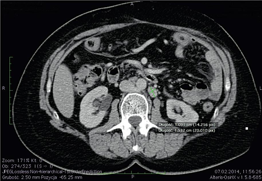 ONKOLOGIA W PRAKTYCE KLINICZNEJ 2015, tom 11, supl. G C B Rycina 10C. Tomografia komputerowa jamy brzusznej: przerzutowy węzeł chłonny zaotrzewnowy Rycina 11B.