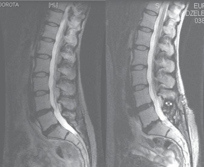 76 D. ZARZYCKI, A. SMĘTKOWSKI, J. LASOTA, P. RADŁO, K. ŁOKAS METHODS Patients were assessed before, 3 months after surgery and next every six month.