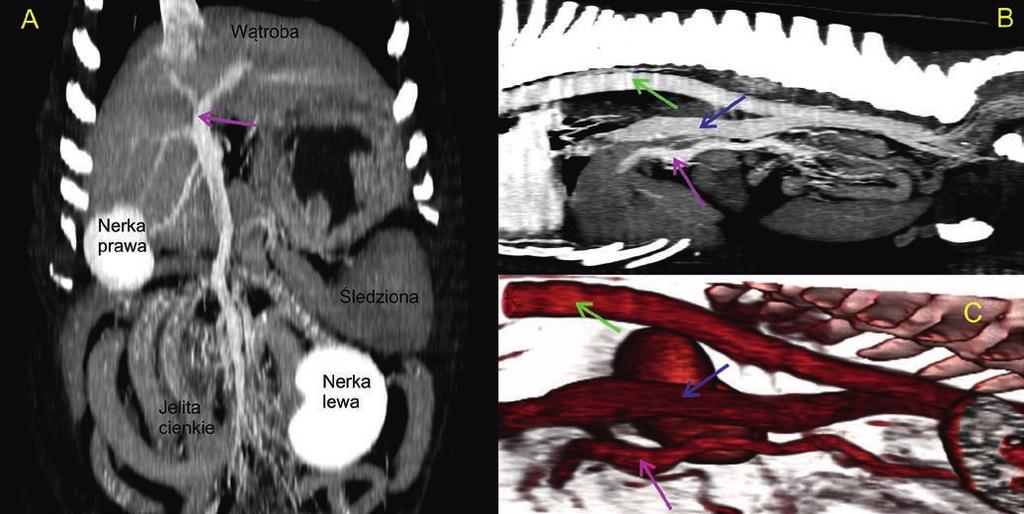DIAGNOSTYKA/RTG ryc. archiwum autora 1 dania nawet przy wykorzystaniu tomografów jednorzędowych. Środek kontrastowy podaje się dożylnie, optymalnie do żyły odpromieniowej.
