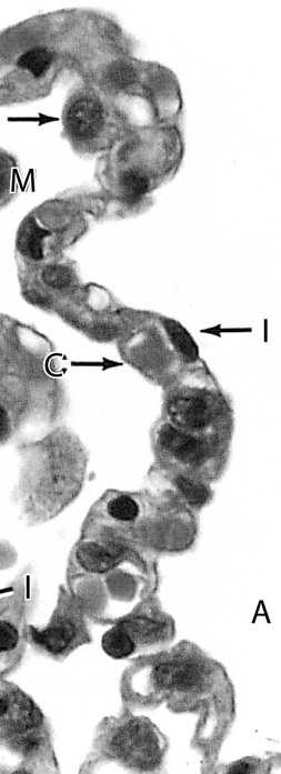 I i II Spłaszczone pneumocyty typu I wchodzą w