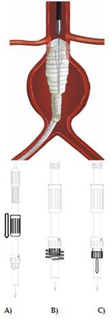 Umieszczanie części aortalnej głównego elementu Umieszczanie odnogi ipsilateralnej Umieszczanie części aortalnej graftu: A) Odciągnąć regulator koszulki do momentu