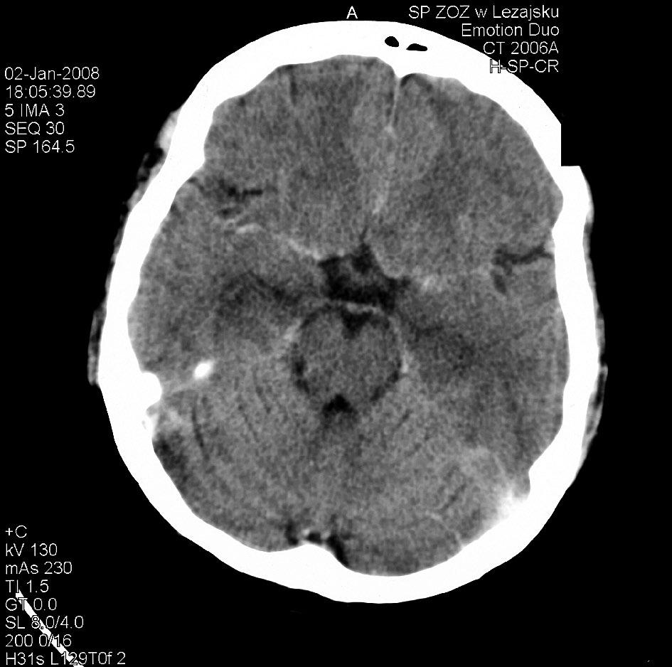 Non-paraneoplastic variant of limbic encephalitis case report Nieparanowotworowy wariant limbicznego zapalenia mózgu opis przypadku hypodense areas within the medial temporal lobes (suspected herpes