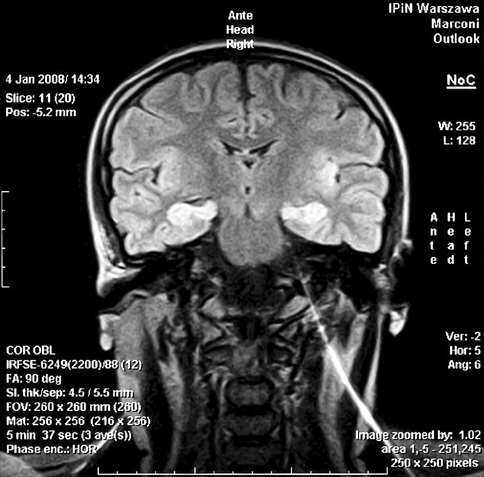 Mariusz Głuszak, Małgorzata Pazderska-Głuszak, Agata Gut-Lepiech, Aleksandra Wierzbicka, Tomasz Litwin, Iwona Kurkowska-Jastrzębska A B Figure II. Magnetic resonance image of the patient s brain.