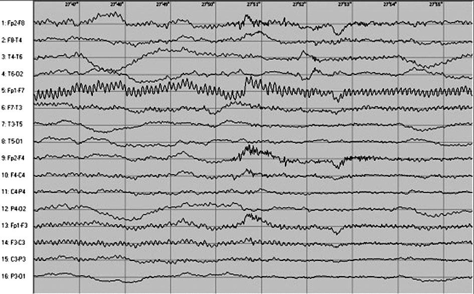 Non-paraneoplastic variant of limbic encephalitis case report Nieparanowotworowy wariant limbicznego zapalenia mózgu opis przypadku A B Figure III.