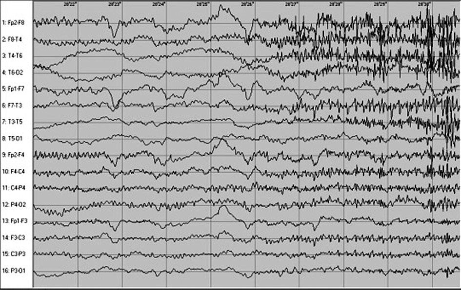 Non-paraneoplastic variant of limbic encephalitis case report Nieparanowotworowy wariant limbicznego zapalenia mózgu opis przypadku E Figure III. Cont. Rycina III. Cd.
