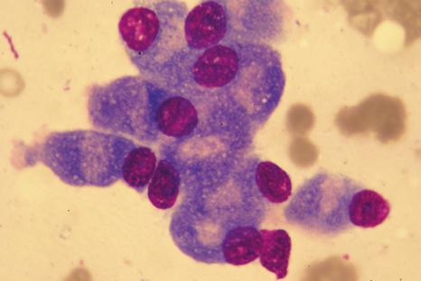 W dostępnym współczesnym piśmiennictwie żaden z autorów nie wskazuje na plazmocyty jako komórki o zmiennej morfologii lub na ich odmienność morfologiczną jako jednego z kryteriów diagnostycznych