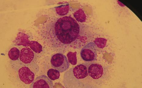 Przedstawione zdjęcia są dowodem istnienia komórek, których morfologia jądra i cytoplazmy znacznie odbiega od komórek określanych mianem prawidłowych plazmocytów.