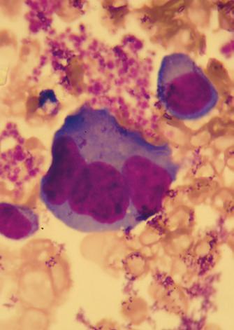 Diagn Lab 2016; 52(4): 251-256 Rycina 16. Trinuklearny plazmocyt z płytkami krwi. Rycina 18. Multinuklearne, olbrzymiokomórkowe formy.