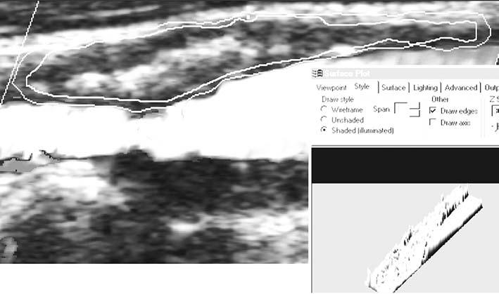 Acta Angiol., 2004, Vol. 10, No. 4 Table 1. Assignment of pixel ranges to the corresponding tissues Tabela 1.