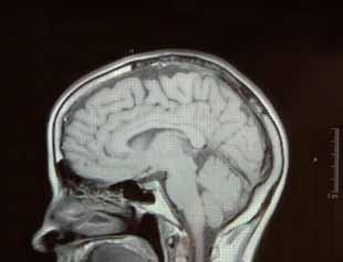 Czym jest choroba Alzheimera?