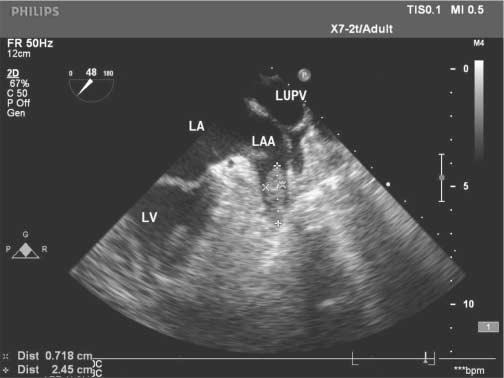 Zastosowanie echokardiografii w diagnostyce i leczeniu migotania przedsionków Ryc. 4. Skrzeplina w LAA (0,7 cm x 2,45 cm), 2D, TEE.