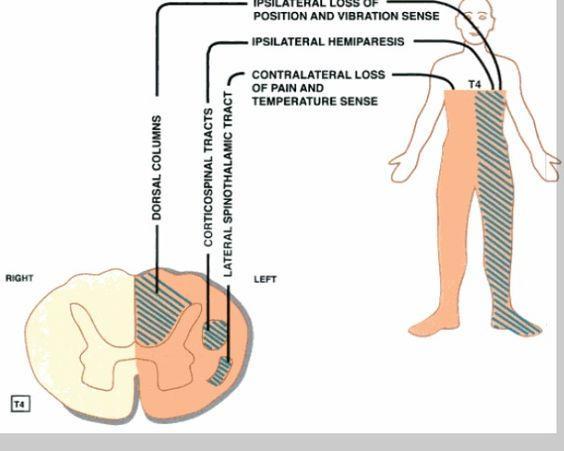 Zespół Brown- Sequarda Polega na połowicznym uszkodzeniu rdzenia kręgowego, którego objawami są: utrata czucia bólu i temperatury