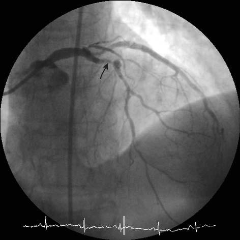 Ryc. 1. Angiogram lewej têtnicy wieñcowej. Strza³k¹ zaznaczono miejsce restenozy w ga³êzi przedniej zstêpuj¹cej Fig. 1. Angiogram of the left coronary artery with restenosis location marked with an arrow Ryc.