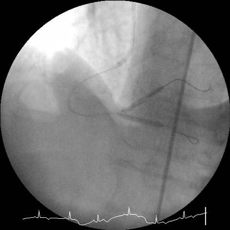 Angiogram przedstawiaj¹cy koñcowy efekt angioplastki bifurkacji prawej têtnicy wieñcowej metod¹ V-stenting Fig. 4.