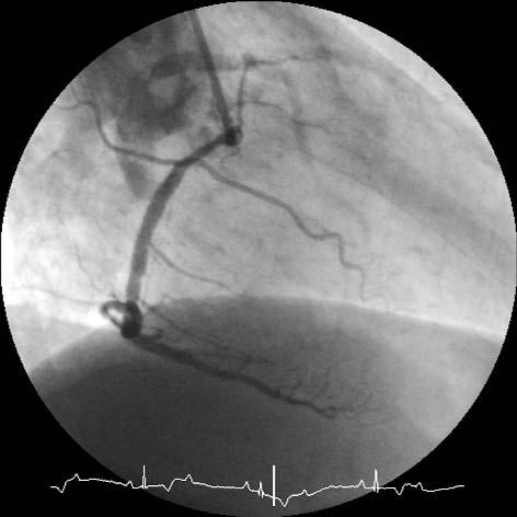 Ryc. 5. Angiogram przedstawiaj¹cy koñcowy efekt angioplastyki prawej têtnicy wieñcowej. W zapisie EKG widoczny blok przedsionkowo-komorowy z bradykardi¹ Fig. 5. Angiogram presenting final result of stenting in the right coronary artery.