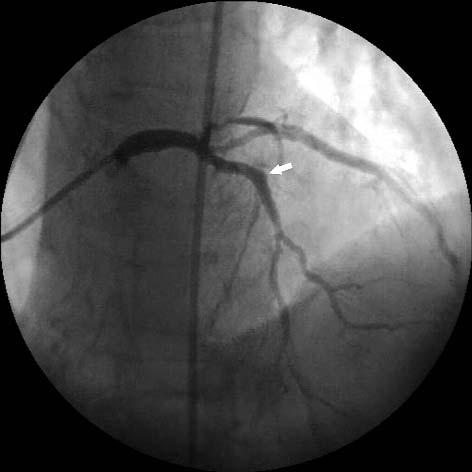 Strza³k¹ zaznaczono miejsce implantacji stentu Fig. 6. Angiogram presenting final result of drug eluting stent implantation into the left descending artery.