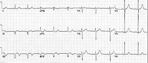 ST elevation,