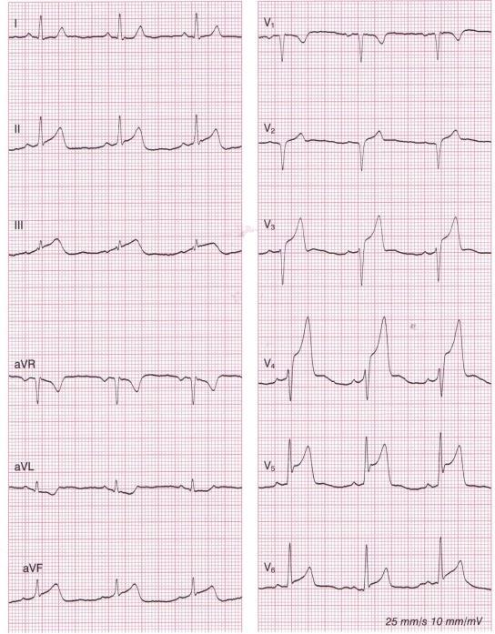 Trudności diagnostyczne -Zespół wczesnej repolaryzacji. Dotyczy zwłaszcza młodych mężczyzn, u których uniesienie ST w p J może przekraczać 2-2,5 mm, zwykle jest wklęsłe - Zapalenie osierdzia.