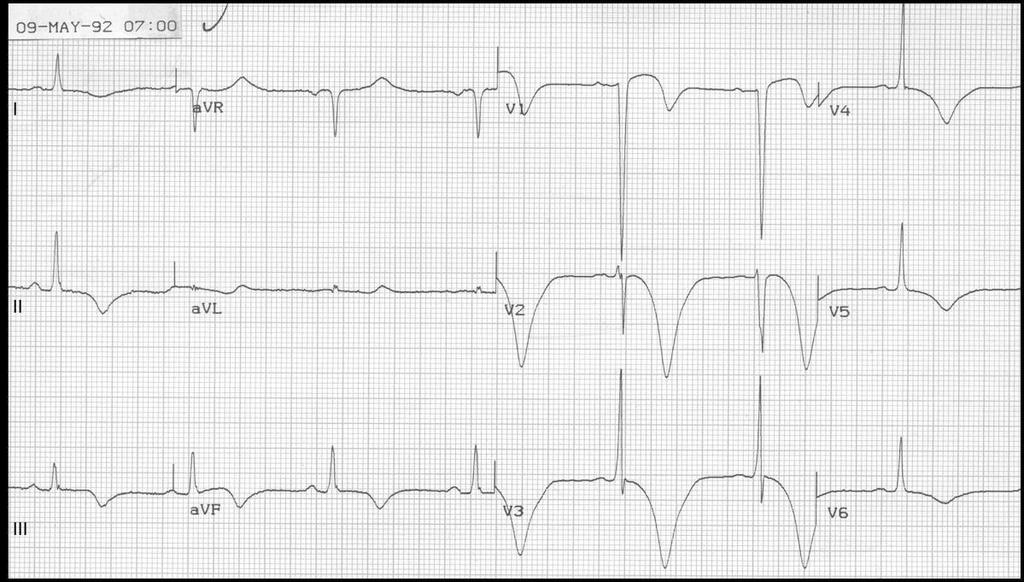NIEDOKRWIENIE - Obniżenie ST w I, II, avl, V3-V6 Przypadek 9 Choroba wieńcowa i niedokrwienie mięśnia serca często przebiegają z wydłużonym
