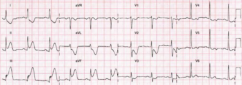 Lokalizacja zawału serca przedni V 2 V 6, I, avl boczny I, avl (czasem V6) dolny tylny ( dolno-podstawny) II, III, avf Obniżenie ST w V2-V3, Kryterium dodatkowe : R>S w