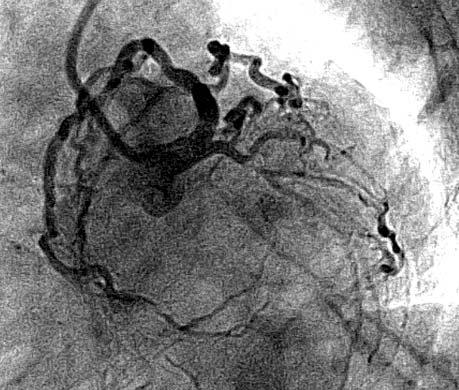 Ostry zespół wieńcowy u chorej po zabiegu przeszczepienia trzustki oraz nerki 645 Rycina 1. Angiografia lewej tętnicy wieńcowej przed zabiegiem angioplastyki Rycina 2.
