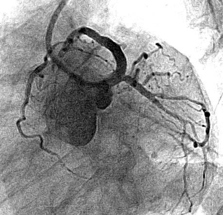 646 Aneta I. Gziut et al Rycina 5. Angiografia lewej tętnicy wieńcowej po implantacji stentów do gałęzi przedniej zstępującej zachowawcze, odraczając koronarografię.
