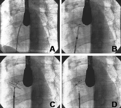 tunel otworu owalnego (du a strza³ka) LP lewy przedsionek, PP prawy przedsionek, GG y³a g³ówna górna Fig. 1. Transoesophageal echocardiography.