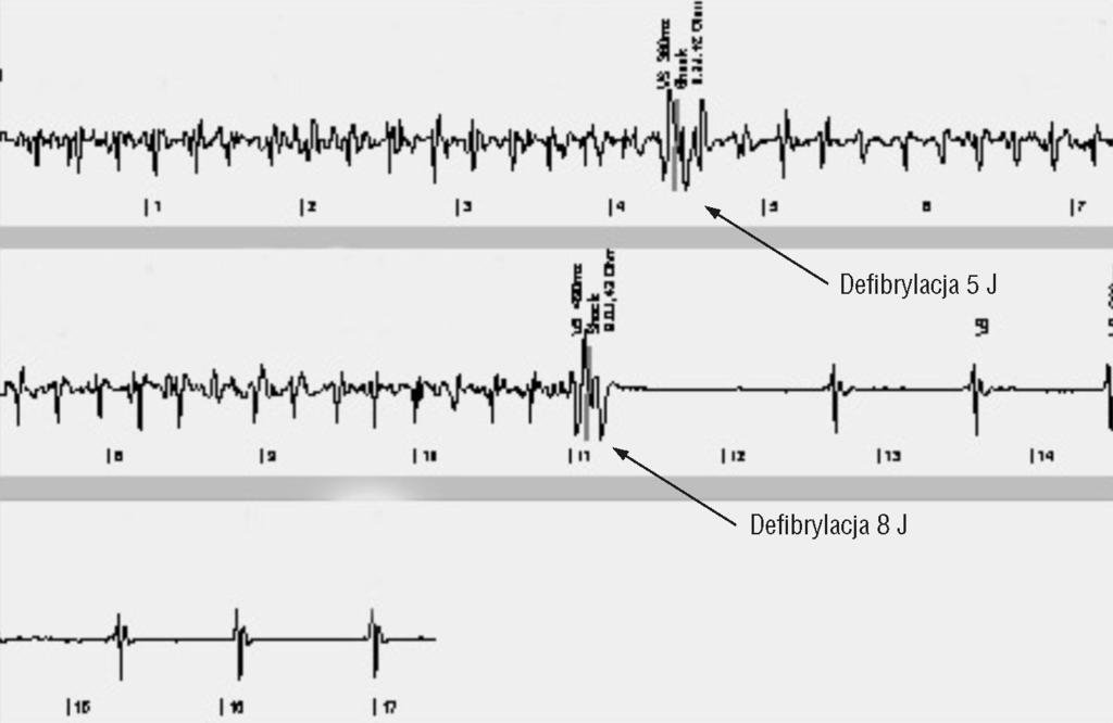 M. Kempa i wsp., Oznaczanie progu defibrylacji migotania komór Rycina 1. Schemat oznaczania progu defibrylacji migotania komór według protokołu ze wzrastającą energią impulsu Figure 1.