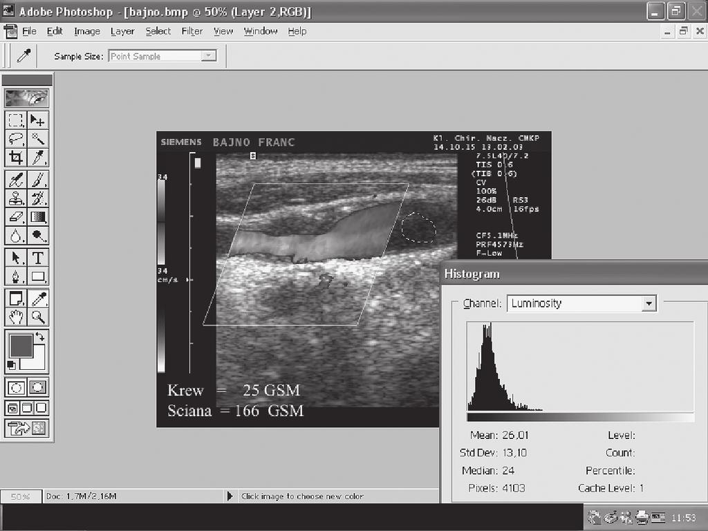 Grzegorz Madycki et al. Ultrasonographic morphology of unstable carotid plaque Polish Surgery 2005, 7, 1 Rycina 1. Metoda analizy z zastosowaniem skali GSM Figure 1.