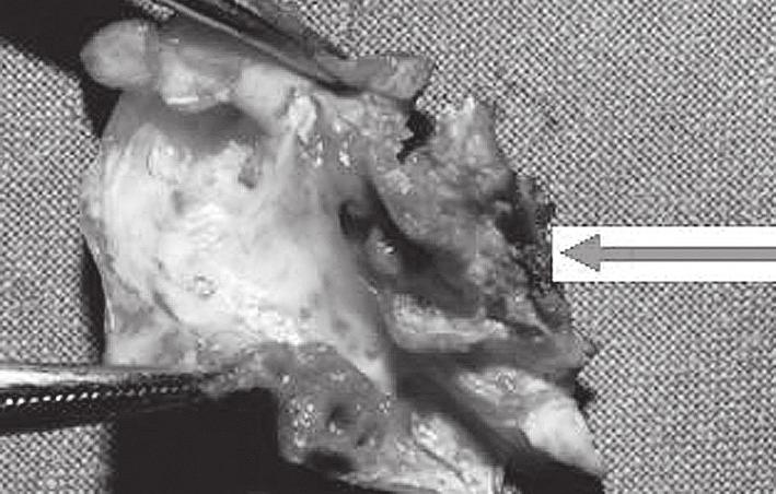 Grzegorz Madycki et al. Ultrasonographic morphology of unstable carotid plaque Polish Surgery 2005, 7, 1 Rycina 3.