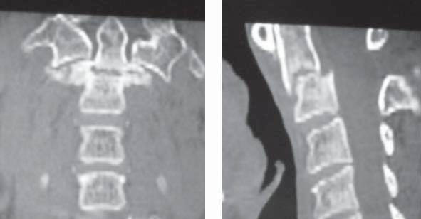58 W. WASILEWSKI, H. KASPRZAK, O. PIERZAK, W. LICZBIK, B. SZOPA, W. KLOC RESULTS The results of the surgical treatment of patients with a fracture of the dens are very good.