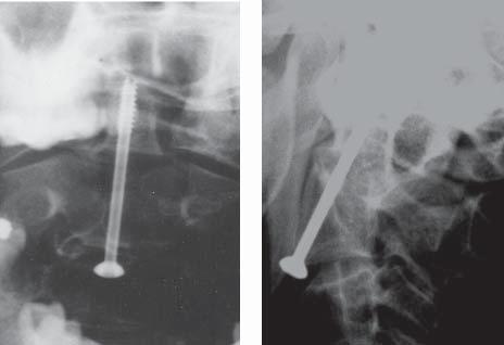 Surgical treatment of dens fractures (also known as odontoid process/vertebra dentata) from frontal access 59 accident is estimated to even 40%.