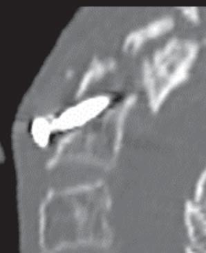 As a result, the carried stabilization gave good treatment results, as the irritation symptoms disappeared after affixing of factions.