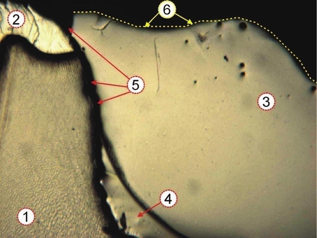 Image of the longitudinal tooth section under optical microscope: 1- dentine, 2-enamel, 3- composite filling, 4-adhesive layer, 5- marginal fissure, 6- chewing surface 6.