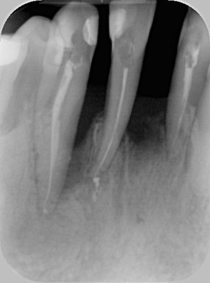 Ryc. 5. Obraz rtg przed zabiegiem, ząb 42 Fig. 5. A X-ray before the procedure, tooth 42 Ryc.