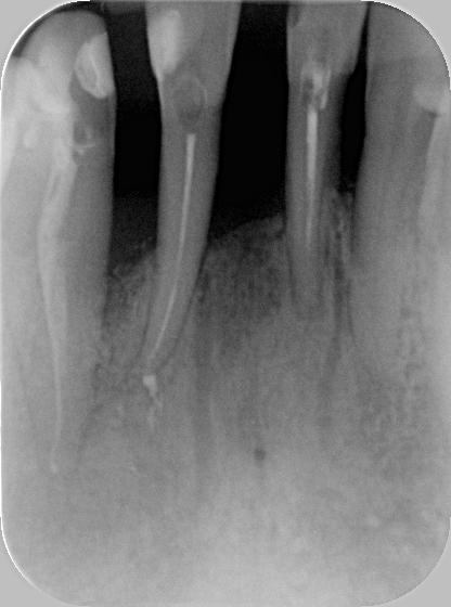 6 A follow up X-ray 6 months after the procedure,