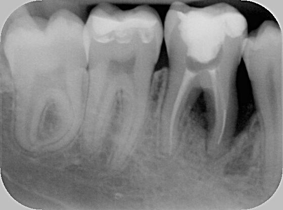 A follow up X-ray 6 months after the procedure, tooth