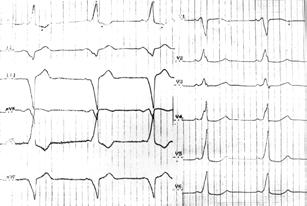 Folia Cardiol. 1999, tom 6, nr 1 Ryc. 1. Przed ablacją: zapis EKG w czasie rytmu zatokowego 66/min.