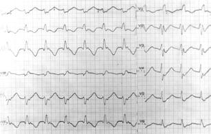 0 ms. Zespół QRS = 15