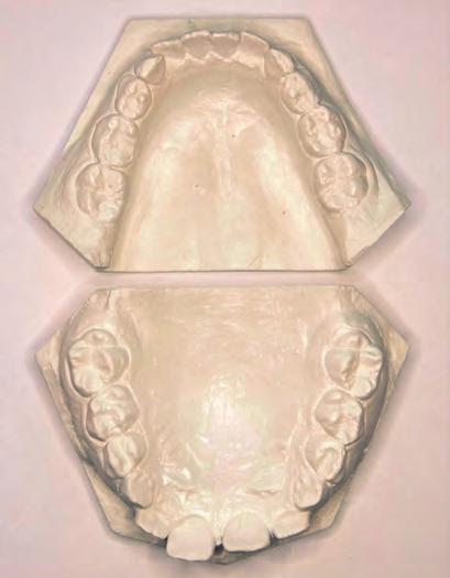 t ec h n i k a dentyst yc z n a Fot. 1a-c. Ortodontyczny model diagnostyczny 1b 1c 1a fot.