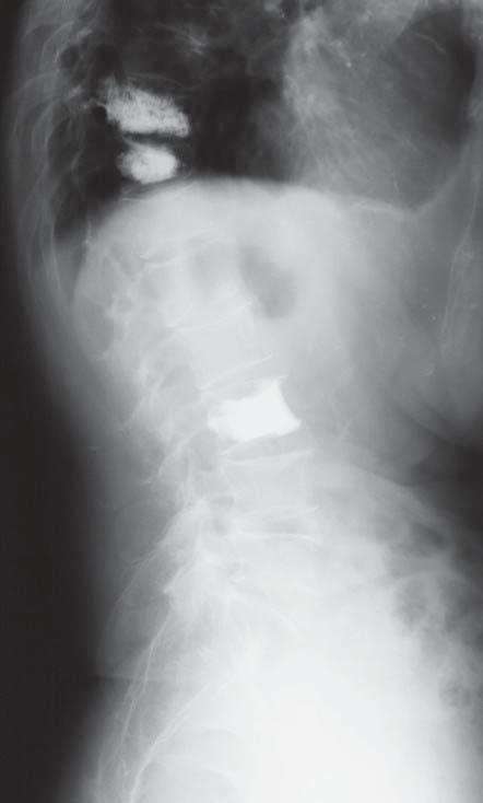 Spośród wszystkich chorych u 7 doszło do kolejnych złamań osteoporotycznych, w tym u 3 chorych w okresie poniżej 3 miesięcy od pierwotnej operacji - złamania trzonów sąsiadujących z