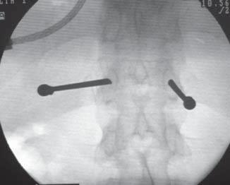 Vertebroplasty in the treatment of osteoporotic spine fractures minimal number of complications [9,10,11,1,13].