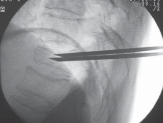 Above that thermal and chemical destruction of free nerve root endings leads to pain reduction [14].