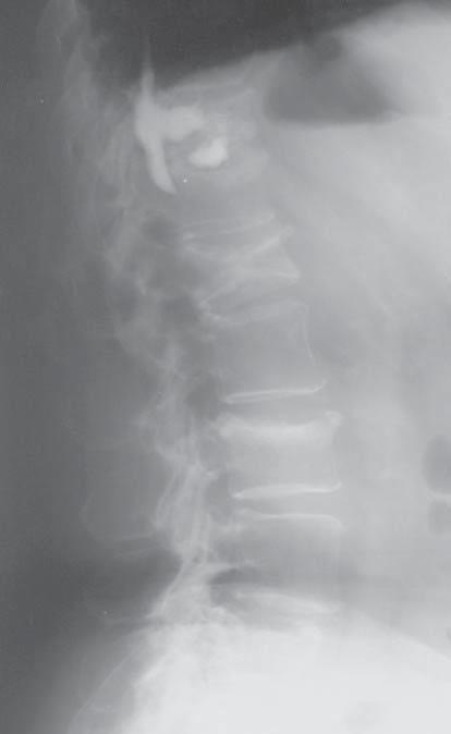 CEL PRACY Celem pracy jest ocena przebiegu oraz wyników leczenia osteoporotycznych złamań kompresyjnych trzonów kręgowych metodą przezskórnej wertebroplastyki. Fig. 1.