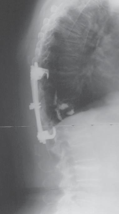 . Trocars introduced into the vertebral pedicles, lateral view Ryc.. Wprowadzone trokary w nasady łuków, widok boczny Fig. 3.