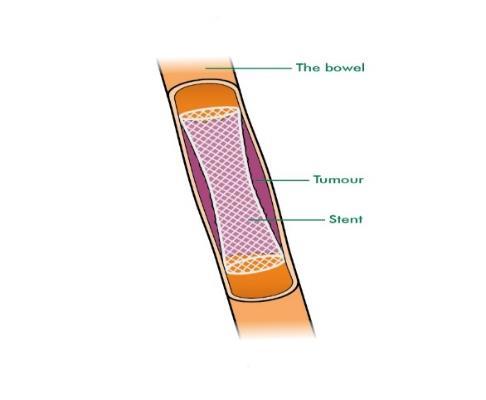 Anterior resection Abdomino-perineal resection Area removed Area removed Types of operation for bowel cancer that has spread Sometimes, colon cancer blocks the bowel and stops poo from passing