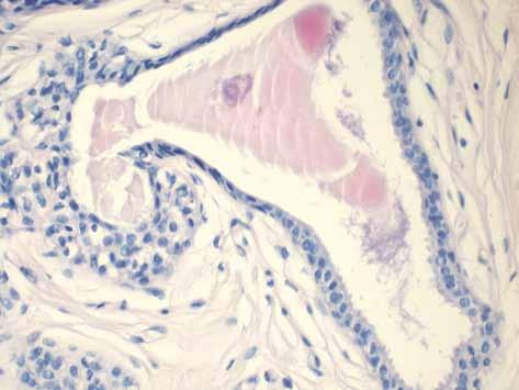 Współwystępowanie columnar cell lesions, LCIS i raka cewkowego łącznie zostało opisane po raz pierwszy przez Rosena w 1999 r. [9], a w 2008 r.