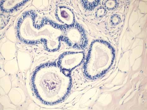 Zmiany walcowatokomórkowe z atypią cytologiczną noszą nazwę płaskich atypowych zmian nabłonkowych (flat epithelial atypia; ryc. 5. 8.).